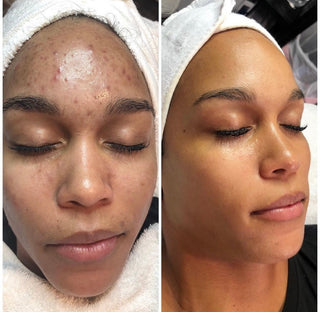 ACNE & DARK SPOTS CONTROL