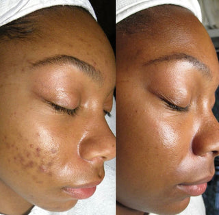 ACNE & DARK SPOTS CONTROL