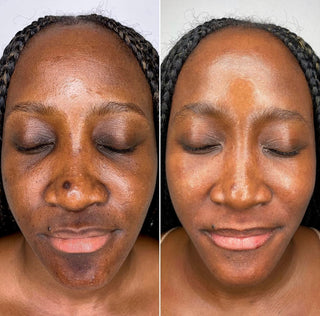 HYPERPIGMENTATION CORRECTOR