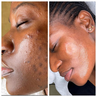 ACNE & DARK SPOTS CONTROL