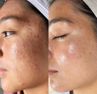 ACNE & DARK SPOTS CONTROL